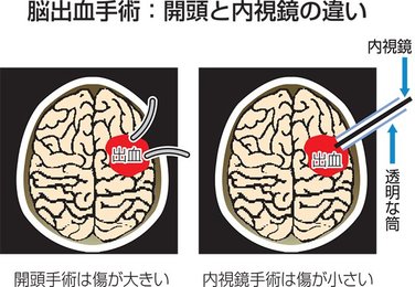 開頭手術 その11 | 岐阜新聞デジタル