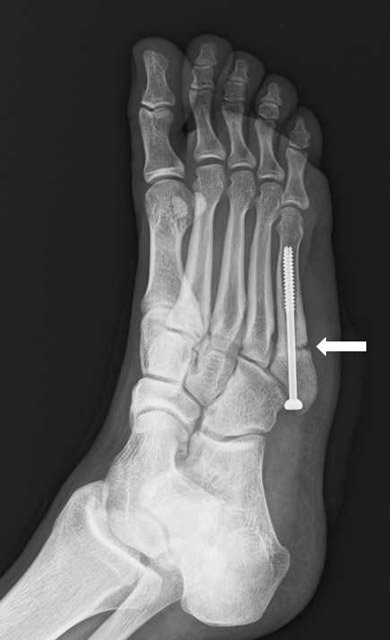 ジョーンズ骨折 岐阜新聞web