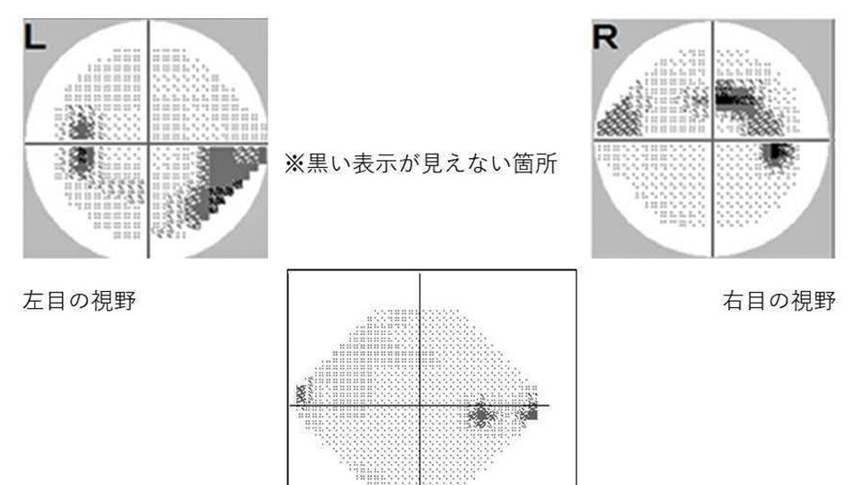 緑内障と運転 | 岐阜新聞Web