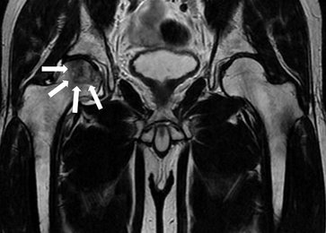 特発性大腿骨頭壊死症の診断 画像検査、保存療法や手術 | 岐阜