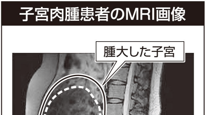 肉腫と癌腫とは何ですか?