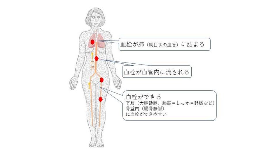 血栓症と避妊薬: このリスクの関係を理解する