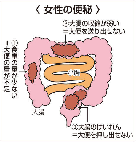 便秘　女 