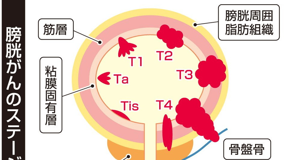 膀胱がん | 岐阜新聞Web
